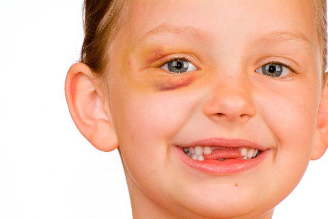 Girl with injury, black eye, missing teeth, hematoma, bruise, teeth, tooth